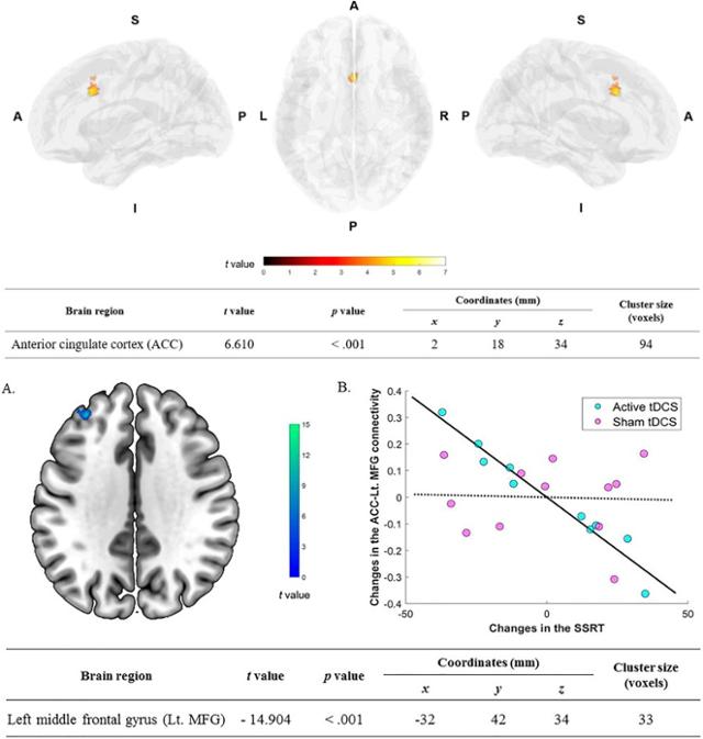 기능적 자기공명영상(fMRI)으로 확인한 경두개 직류 자극 치료 전후 변화된 뇌 영역. 서울성모병원 제공