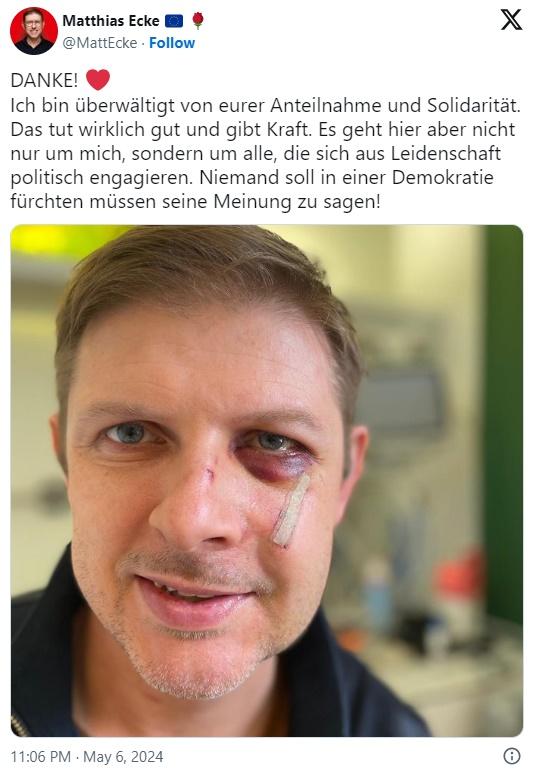 지난 3일 독일 작센주 드레스덴에서 선거 포스터를 붙이던 중 집단 폭행을 당한 사회민주당(SPD) 소속 마티아스 에케 유럽의회 의원이 6일 자신의 멍든 눈을 촬영해 사회관계망서비스(SNS) 엑스(X)에 게시했다. 본인 X 계정 캡처