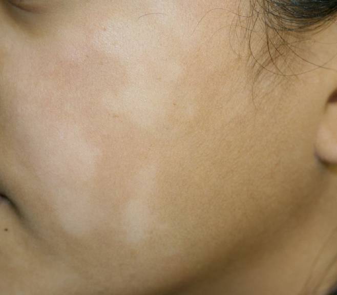 버짐이 생겼을 때 햇빛 노출을 삼가고 꾸준히 보습 관리를 해주면 대부분 정상적인 피부로 돌아온다./사진=International Journal of Dermatology