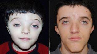 세이트리 챠즌 증후군 환자들은 머리가 위로 뾰족하게 솟은 모양(뾰족머리증)을 보이고, 두개골과 얼굴의 여러 뼈가 왜곡돼서 자란다./사진=Children’s Hospital of Philadelphia