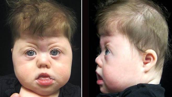 세이트리 챠즌 증후군 환자들은 머리가 위로 뾰족하게 솟은 모양(뾰족머리증)을 보이고, 두개골과 얼굴의 여러 뼈가 왜곡돼서 자란다./사진=Children’s Hospital of Philadelphia