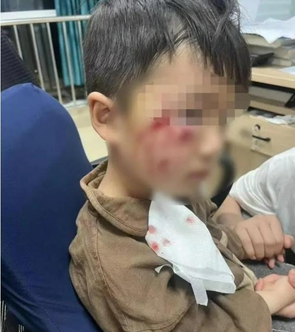 중국 길거리에서 개에게 물린 3세 남자아이가 18일 만에 사망했다. 사진 출처 중국신문주간