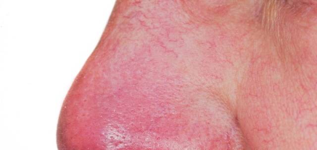 주사는 여드름, 접촉성 피부염 등과 혼동하기 쉽다. 얼굴이 지속적으로 붉어지거나 홍조, 모세혈관 확장 등의 증상이 계속된다면 피부과 전문의를 찾아 정확한 진단을 받을 필요가 있다. /클립아트코리아