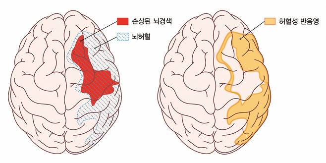 붉은색 부위는 손상된 뇌경색 중심부, 파란 빗금 부위는 뇌경색 중심부를 포함한 뇌허혈 부위, 노란색 부위는 급성기 치료의 중심 허혈성 반음영 부위다. /그림=강동경희대병원
