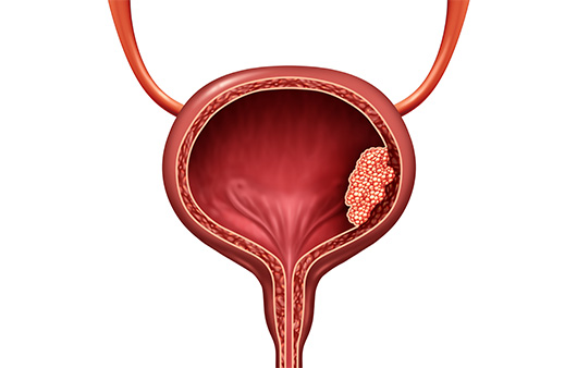 국내 방광암 환자수가 증가하는 가운데, 일상 속 예방수칙 준수가 당부된다｜출처: 게티이미지뱅크