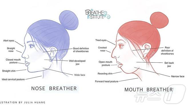 코로 숨을 쉬는 사람의 얼굴형(왼쪽)과 입으로 숨을 쉬는 사람의 얼굴형(청담 본큐어한의원 제공)