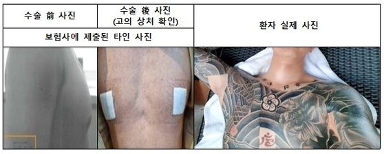 보험사에 허위로 제출된 수술 전후 사진. 서울경찰청 제공