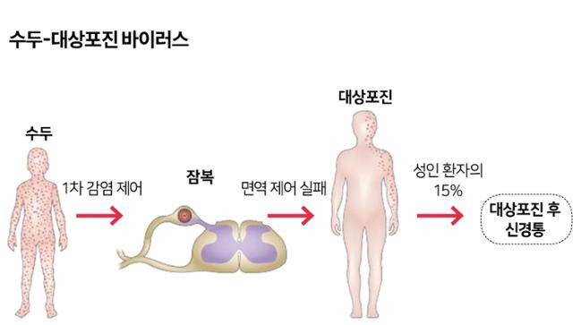 수두-대상포진 바이러스