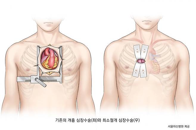 개흉심장수술과 최소절개 심장수술
인포그래픽|서울아산병원 제공