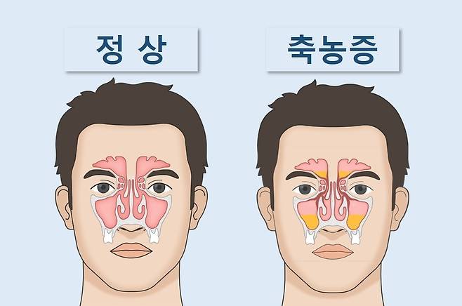 부비동에 고름이 찬 모습 [하나이비인후과병원 제공]