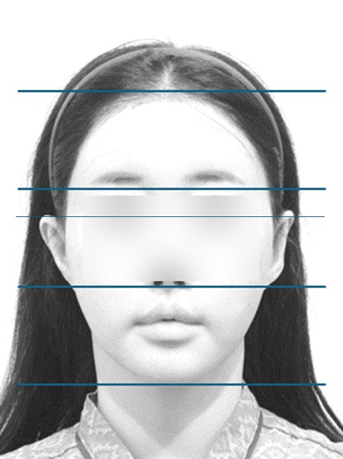 중안면이 긴 얼굴에서 이마 거상을 시행하면 중안면이 더 길어지며 얼굴 전체가 길어 보입니다.