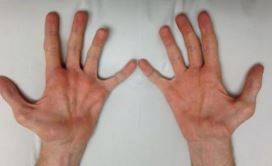 샤르코-마리-투스 병은 운동신경과 감각신경이 손상되는 희귀 유전질환이다./사진=Reviews in Biotechnology and Biochemistry