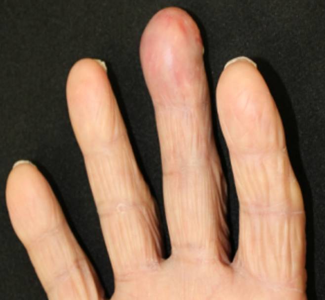 오른손 가운데 손가락에 암 전이가 일어나 부종, 홍반이 나타난 모습./사진=임상사례보고