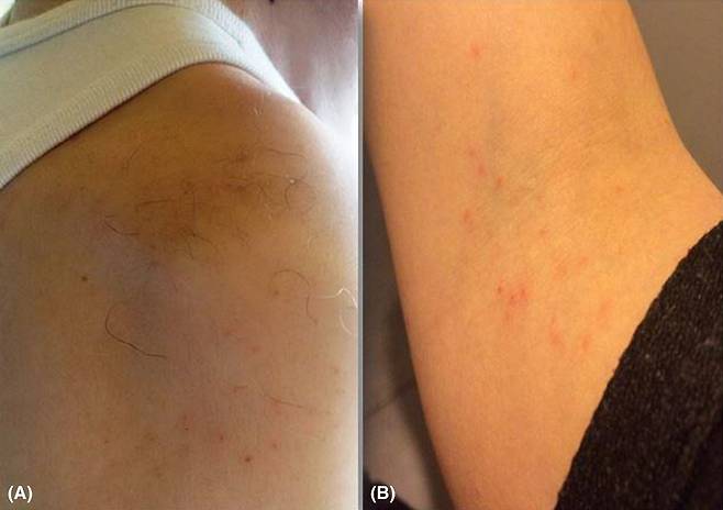 비둘기에서 발견되는 ‘닭진드기(Dermanyssus)’에 감염된 사례가 두 건 보고됐다. 비둘기 접촉으로 인해 닭진드기에 감염돼 발생한 피부 병변./사진=임상사례보고