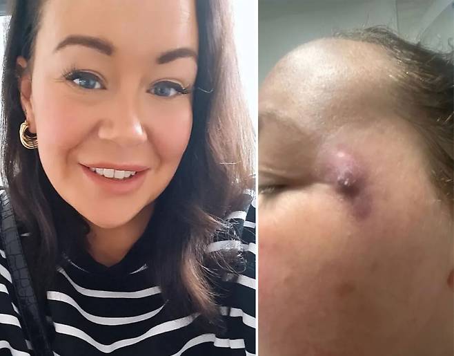 영국 40대 여성 캣 램지는 보톡스를 맞은 후 얼굴에 종기가 생겼다. 병원에서는 주삿바늘을 위생적으로 관리하지 않아 발생한 교차오염 때문으로 추정했다./사진=더선 홈페이지 캡처