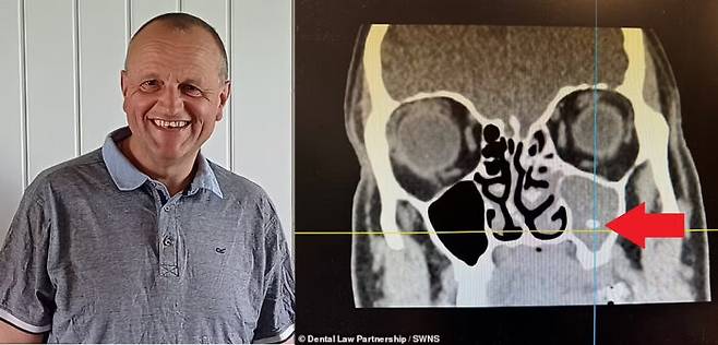 영국의 마크 샤이어(58)는 2년간 극심한 부비동 통증을 겪었다. CT 검사 결과 그의 부비동에 치아의 일부가 위치하고 있었다. [사진=데일리메일 보도 갈무리 / SWNS 'Dental Law Partnership']