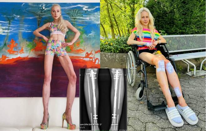 사지연장술로 다리를 15cm 늘린 여성이 철심을 제거하는 마지막 수술을 받고 퇴원했다는 사연이 소개됐다. [사진 = '더선' 보도내용 캡처]