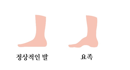 정상적인 발과 요족. [사진=나누리병원]