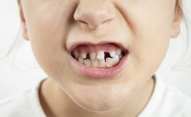유아와 청소년기엔 충치 등 구강질환은 성인들보다 매우 빠르게 진행한다. 따라서, 질환이 의심될 땐 빨리 치과에 방문해 검진과 치료를 받고 치아 관리법을 안내받는 게 좋다. [사진=게티이미지뱅크]