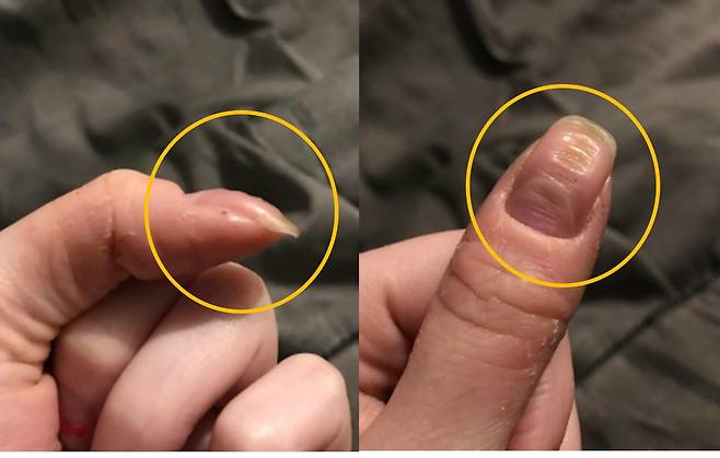 몇 년째 손톱이 융기된 채로 지내고 있다며, 해당 사진을 올린 여성의 손톱 상태에 많은 사람들이 자신의 손톱 상황을 공유하며 때아닌 손톱 모양이 이슈가 되고 있는 모양새다. [사진=영국 일간 미러 / 레딧 캡처]