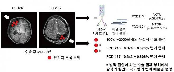 국소피질이형성증 환자 유전진단에서 매우 낮은 수준의 유전 변이가 발작과 연관될 수 있음을 규명한 연구 모식도. KAIST