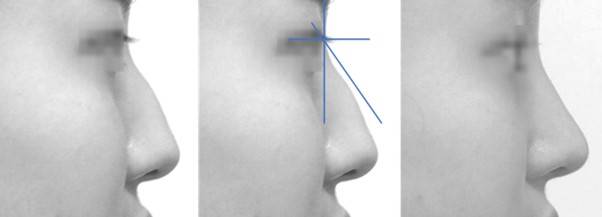 한국인의 '매부리코'에서 다수는 코끝만 높여줘도 됩니다.