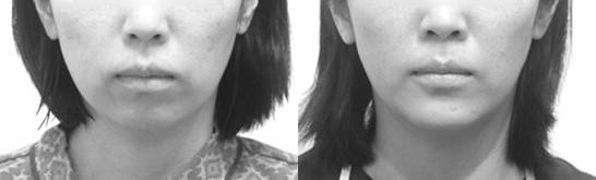 턱이 뒤로 빠져 인중이 길어 보이면, 원인은 턱에 있습니다.