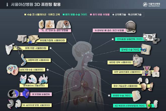 서울아산병원 3D프린팅 활용.