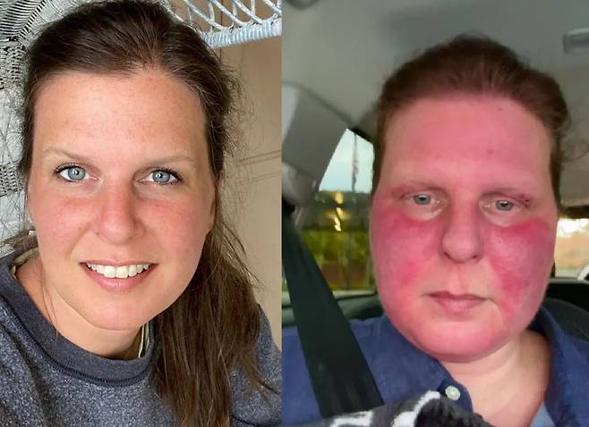 피어싱 뚫기 전의 라라의 모습(왼)과 피어싱을 뚫고 얼굴과 목이 모두 빨갛게 변한 라라의 모습(오)/사진=더 선