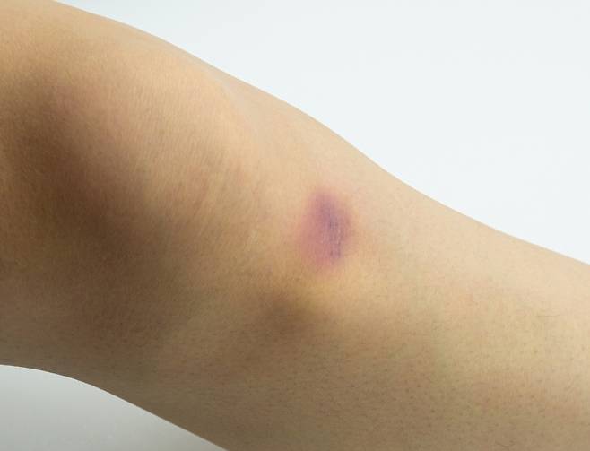 나이가 들면 혈관 주변 조직이 약해지면서 멍이 잘 생긴다./사진=클립아트코리아