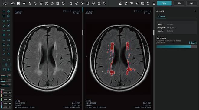 대뇌백질변성분석 AI 솔루션 JLK-WMH의 시연 장면./사진=제이엘케이