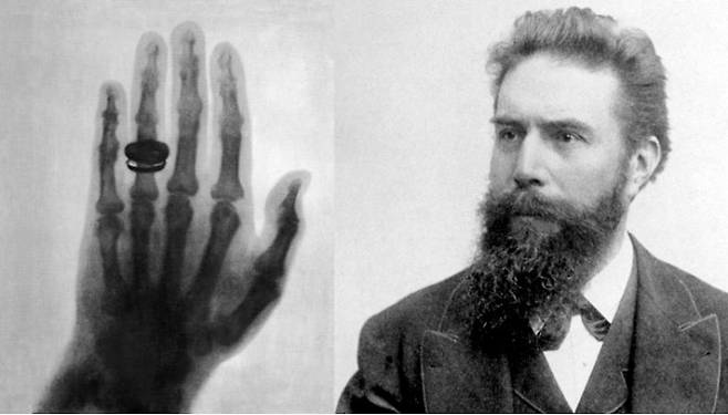 쾰리커의 반지를 낀 X선. 위키미디어 제공