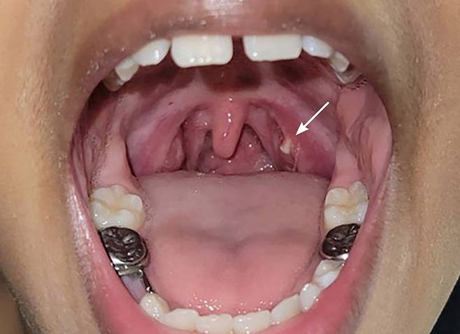 흰 화살표가 가리키는 곳에 편도결석이 끼어 있는 모습./사진=2023 American Academy of Family Physicians