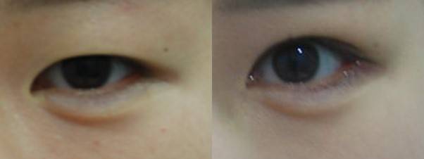 쌍꺼풀 수술로 눈 앞머리를 가리는 피부를 접어주면 앞쪽 느낌이 좋아짐.