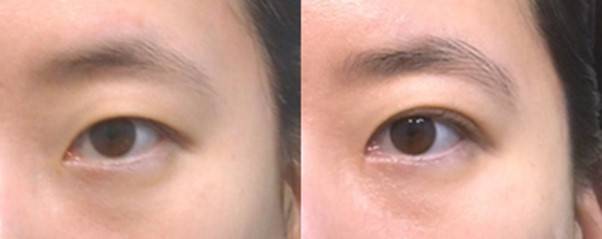 쌍꺼풀 수술과 함께 '위트임'을 시행해 눈앞머리쪽이 떨어지는 느낌이 완화됨.