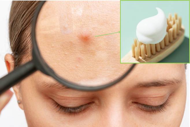 얼굴에 여드름 하나만 불그스레 올라와도 거슬립니다. 이 여드름을 빨리 가라 앉히기 위해 별별짓(?)을 다 해보지만 여차하면 덧나기 일쑤죠. 이 별별짓 중 하나로 치약을 바르는 방법도 있는데요. 괜찮은걸까요? [사진=게티이미지뱅크]