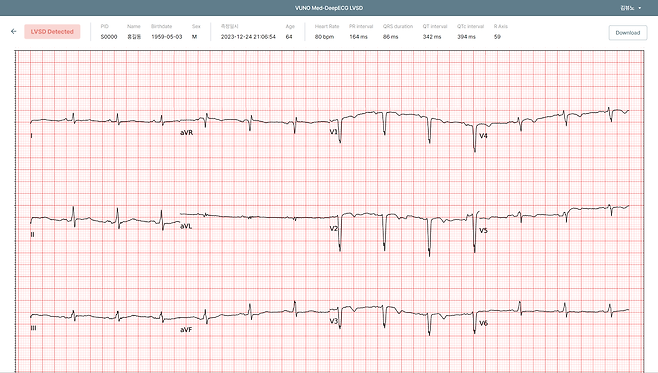 뷰노의 AI 기반 심부전 선별 소프트웨어 '뷰노메드 딥ECG LVSD'의 운영화면./뷰노