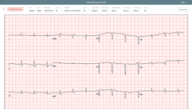 뷰노메드 딥ECG LVSD