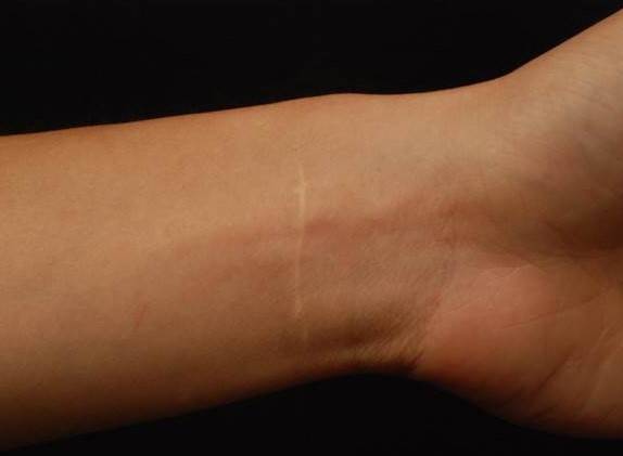 손목에 생긴 주저흔. /사진=연세스타피부과의원