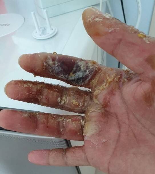 지난 5월27일 삼성전자 기흥공장에서 작업 중 방사능에 피폭된 노동자가 자신의 손 모습이라며 올린 사진. 전국삼성전자노동조합 누리집 갈무리