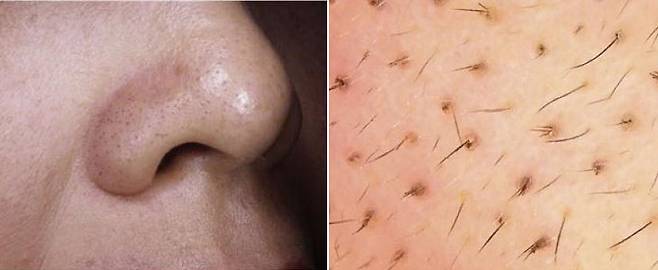 털이 뭉쳐 블랙헤드처럼 보이는 것을 소극성 속모증이라 한다./사진=미국피부과학회지(JAAD)