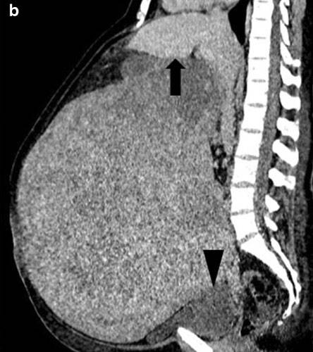 거대 자궁근종으로 뱃속이 가득 차있는 독일 여성의 CT 사진./사진=의학사례보고저널