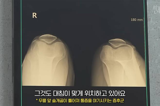 션 무릎 상태