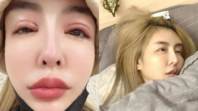 대만의 한 인플루언서가 성형수술 후유증을 고백했다./사진=방기원 소셜미디어 캡처