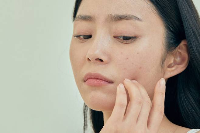 여드름은 자존감 저하와 더불어 사회생활에도 부정적 영향을 주기도 한다. [사진=게티이미지뱅크]