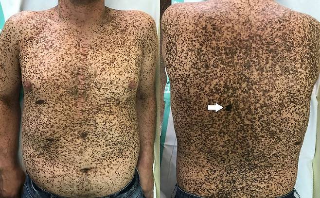 레오파드 증후군이 있으면 흑색이나 갈색 반점(Lentingines)이 전신에 산발적으로 나타난다./사진=Actas Dermo-Sifiliográficas