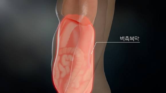 막이란 우리 배 속의 장기를 감싸고 보호하는 역할을 하는 얇은 막이다. 복막암은 크게 두 가지 종류로 나눌 수 있는데, 암이 처음부터 복막에서 시작된 원발성 복막암과 다른 장기에서 시작되어 전이된 전이성 복막암이 있다. [사진=EBS]