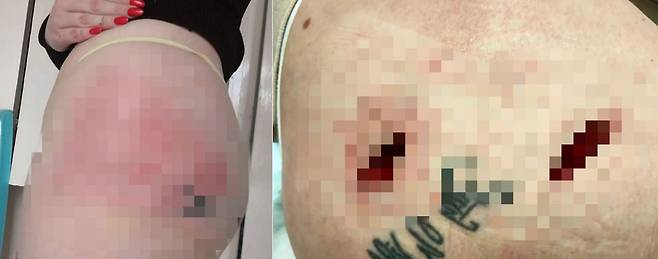 북아일랜드에 살고 있는 멜리사 크로포드(30)는 출산 이후 자신의 볼륨 없는 몸매가 싫어 BBL 수술을 받았지만 통증으로 필러를 빼내 보기 흉한 흉터가 남았다./사진=더선 캡처