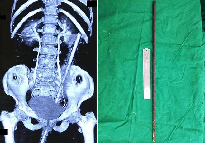 아침에 소를 방목하던 중 미끄러져 금속 이물질에 찔린 60대 여성의 사례가 공개됐다. 사진은 쇠막대기가 들어있는 여성의 복부 ct(왼쪽)와 수술로 제거한 쇠막대기(오른쪽) 사진이다./사진=국제외과저널 사례보고