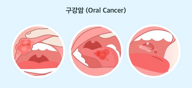 구강암은 입술, 혀, 입 천장 등 입 안에 발생하는 모든 암을 말한다. {사진=코메디닷컴 DB}